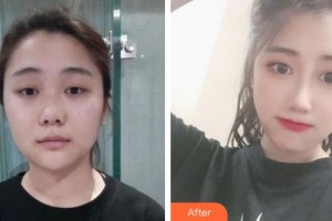 上海麗質(zhì)整形美容醫(yī)院史正忠整形價(jià)格表附肋軟骨隆鼻案例展示