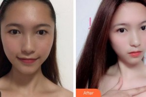 上海麗質(zhì)整形美容醫(yī)院陳新平整形價(jià)格表附洛麗塔眼部手術(shù)案例展示