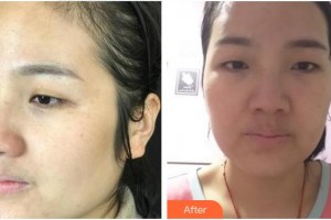 上海鷗美藥妝醫(yī)療美容門診部翁秀麗整形價(jià)格表附超激光美膚祛斑案例展示