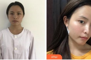 上海臻妮醫(yī)療美容門診部湯玉祥，男，主治醫(yī)生，畢業(yè)整形價格表附創(chuàng)可貼面部吸脂瘦臉案例展示