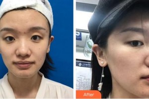 上海麗鉑醫(yī)療美容門診部大井弘一整形價格表附皮膚管理案例展示