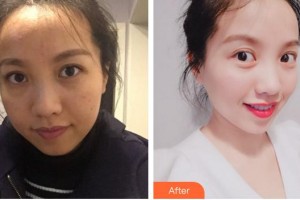 上海麗鉑醫(yī)療美容門診部淺井真太郎整形價格表附巨補(bǔ)水祛除暗沉淡化眼紋案例展示