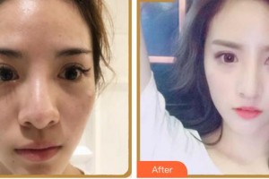 上海微藍(lán)醫(yī)療美容門診部鄭珉在整形價格表附鼻部多項(xiàng)案例展示