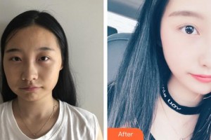 上海瑰康醫(yī)療美容門診部李南整形價格表附磨骨案例展示