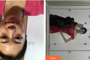 上海韓鏡醫(yī)療美容醫(yī)院尹弘錫整形價格表附點(diǎn)陣激光案例展示