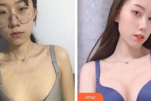 上海賽美瑞醫(yī)療美容門診部張化舉整形價格表附濃縮豐胸真實(shí)案例展示