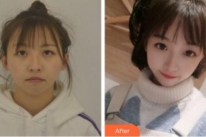 上海柏薈醫(yī)療美容門診部黃耀麟整形價格表附下頜角+皮質(zhì)骨+夾脂墊案例展示