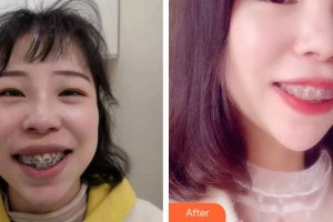 上海雅悅口腔門診部薛云華整形價格表附金屬托槽矯正牙齒案例展示