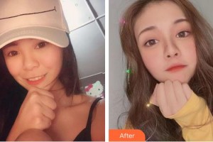 上海柏薈醫(yī)療美容門診部彭賢禮整形價格表附玻尿酸導(dǎo)入案例展示