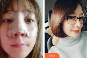 上海醫(yī)顏醫(yī)療美容門診部李曙光整形價格表附鼻部手術(shù)案例展示