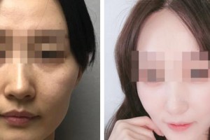 上海醫(yī)顏醫(yī)療美容門診部余韋臻整形價格表附熱瑪吉案例展示