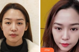 上海和平眼科醫(yī)院張麗梅整形價格表附眼部綜合案例展示
