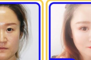 上海?，斎鹨曆劭漆t(yī)院張偉英整形價格表附眼部綜合案例展示