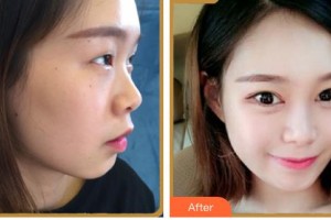 成都美立方（原華博）醫(yī)療美容醫(yī)院弘潤基整形價格表附眼部綜合案例展示