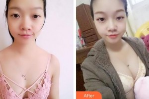 成都美立方（原華博）醫(yī)療美容醫(yī)院王強整形價格表附隆胸案例展示