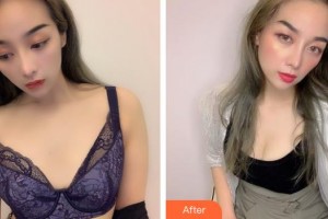 成都米蘭柏羽醫(yī)學(xué)美容醫(yī)院蔣中川整形價格表附濃縮豐胸真實案例展示