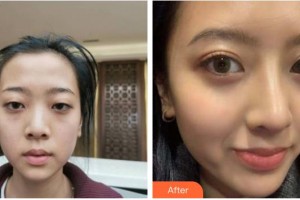 成都藝星醫(yī)療美容醫(yī)院蔡靈整形價格表附半肋鼻部手術(shù)案例展示