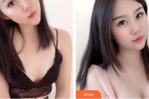 成都藝星醫(yī)療美容醫(yī)院劉曉榮整形價格表附濃縮豐胸真實案例展示