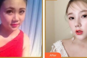 成都市第三人民醫(yī)院醫(yī)學整形美容科王俸棋整形價格表附鼻部綜合案例展示