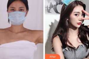 成都市第三人民醫(yī)院醫(yī)學整形美容科梁靜萍整形價格表附手臂吸脂案例展示