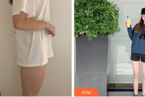 成都市第三人民醫(yī)院醫(yī)學整形美容科葉飛輪整形價格表附大腿吸脂案例展示