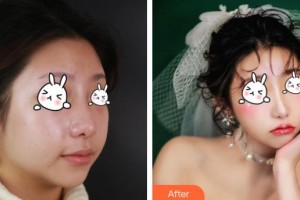 成都市第三人民醫(yī)院醫(yī)學整形美容科段冬梅整形價格表附紅寶石激光祛斑案例展示