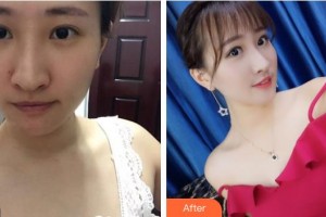 成都儀美醫(yī)療美容門診部周儀整形價格表附鼻部手術案例展示