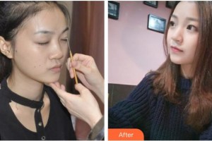 成都米蘭柏羽醫(yī)學美容醫(yī)院唐林俊整形價格表附假體隆鼻+鼻頭塑形案例展示