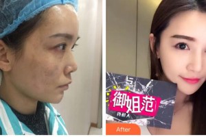 成都米蘭柏羽醫(yī)學美容醫(yī)院王煬整形價格表附激光美膚祛斑案例展示