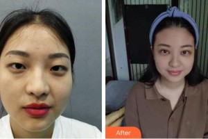 成都西區(qū)醫(yī)院醫(yī)學美容科瑪麗整形價格表附眉毛不上揚案例展示