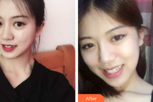 廣州星團醫(yī)學美容門診部邱煥標整形價格表附面部輪廓案例展示