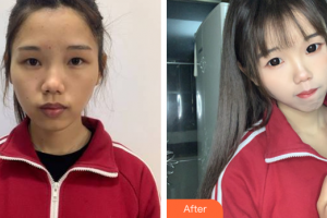 廣州廣美整形美容醫(yī)院王國權整形價格表附面部吸脂案例展示