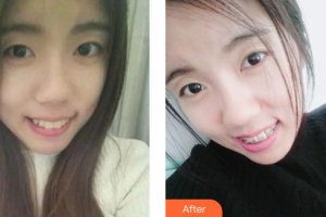 廣州華美醫(yī)療美容醫(yī)院張毓整形價格表附金屬托槽矯正案例展示