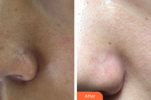 廣州曙光醫(yī)學美容醫(yī)院鐘金源整形價格表附水氧活膚案例展示