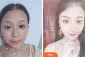 廣州華美醫(yī)療美容醫(yī)院王洪勇整形價格表附無針水光案例展示