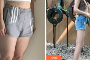 廣州華美醫(yī)療美容醫(yī)院郝永生整形價格表附吸脂瘦大腿案例展示