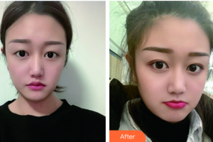 廣州市白云區(qū)第一人民醫(yī)院燒傷整形科董玉明 整形價格表附埋線雙眼皮案例展示