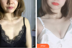 廣州市紅十字會醫(yī)院燒傷整形科童仁聯(lián)整形價格表附自體脂肪隆胸案例展示