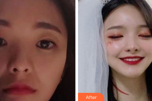 廣州南珠醫(yī)療美容門診部張瑤整形價(jià)格表附嫩膚美白案例展示