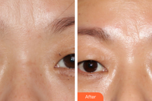 廣州博仕整形美容醫(yī)院吳佳純整形價(jià)格表附汗管瘤案例展示