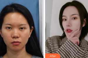 廣州南珠醫(yī)療美容門診部黃文博整形價(jià)格表附鼻部整形案例展示