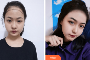 廣州新發(fā)現(xiàn)植發(fā)連鎖機(jī)構(gòu)魯聰聰整形價(jià)格表附發(fā)際線種植案例展示