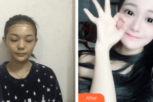 廣州新發(fā)現(xiàn)植發(fā)連鎖機(jī)構(gòu)宋振寧整形價(jià)格表附種植發(fā)際線案例展示