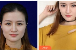 成都風尚格致醫(yī)學美容整形醫(yī)院鄧朝東整形價格表附白竹案例展示