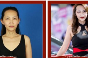 成都米蘭柏羽醫(yī)學美容醫(yī)院宋淑萍整形價格表附假體隆胸案例展示