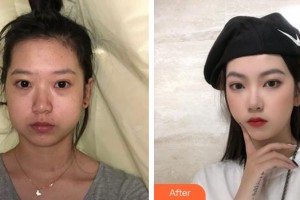 成都美容整形醫(yī)院馮春雨整形價格表附下頜角磨骨案例展示