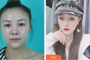 成都漢密爾頓美容醫(yī)院金世泳整形價格表附鼻部綜合案例展示