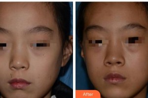 成都漢密爾頓美容醫(yī)院穆赫蘭整形價格表附激光點痣案例展示