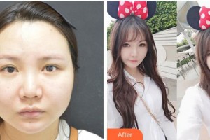 成都名府整形外科門診部楊漢城整形價格表附面部溶脂案例展示