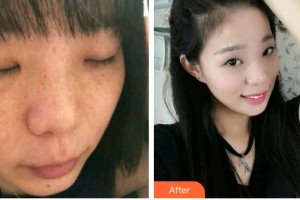 成都華西保健醫(yī)院整形美容中心馬德強(qiáng)整形價格表附雙機(jī)祛斑案例展示